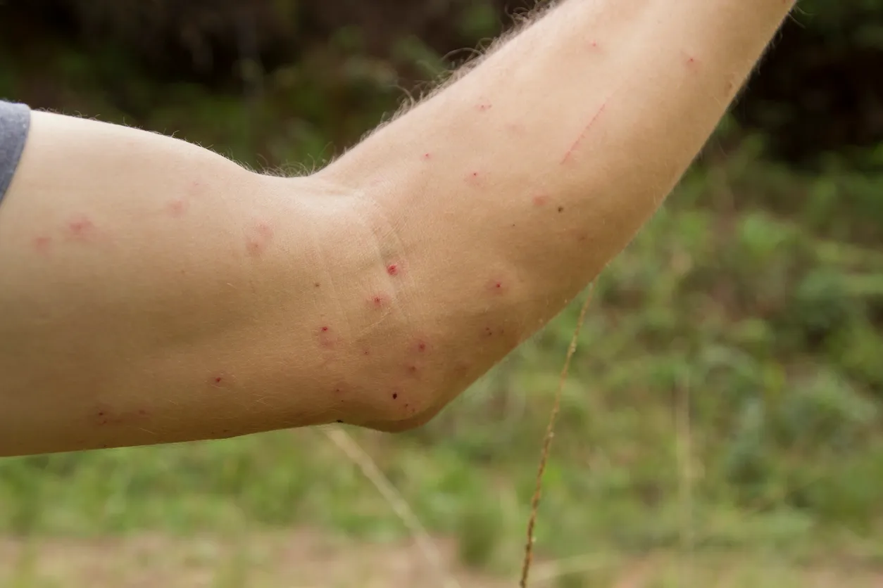 Hombre blanco muestra su brazo con marcas de urticaria debido a picaduras de mosquitos